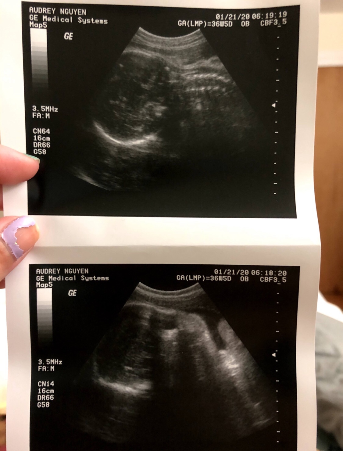 36 week ultrasound breech baby